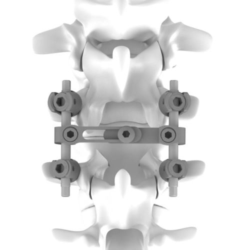 Sistema de osteosíntesis toracolumbar - K.M. - NEURO FRANCE Implants - vía posterior / para adulto