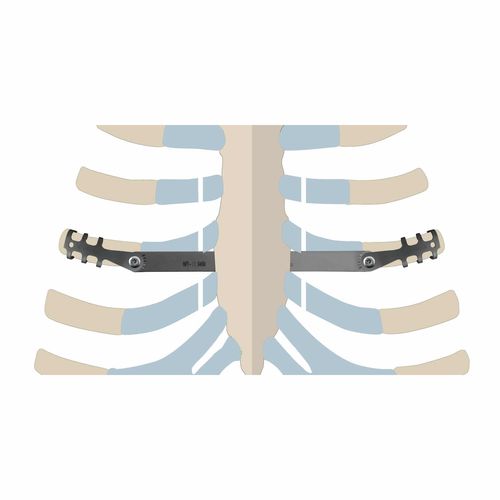 Placa de compresión para costillas - ThoRib® PECTUS - NEURO FRANCE Implants - de titanio / pediátrica