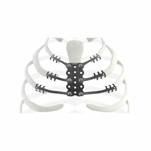 Prótesis costal para la reconstrucción tras resección de osteosarcoma - TRIONYX® - NEURO FRANCE Implants