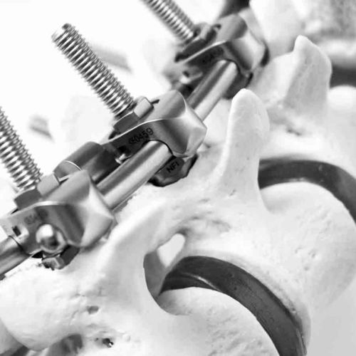 Sistema de osteosíntesis toracolumbar - S.E.S+ - NEURO FRANCE Implants - vía posterior / para adulto