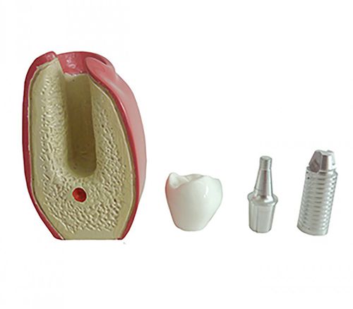 Modelo anatómico para odontología - 9764  - Nacional Ossos - de implantología / de prótesis dental / de formación