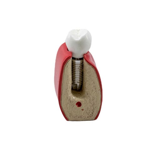 Modelo anatómico para odontología - 9764  - Nacional Ossos - de implantología / de prótesis dental / de formación