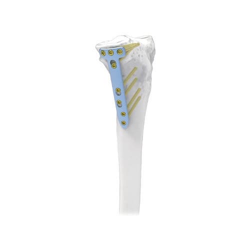 Placa de osteotomía para tibia - NORMMED Medical Devices - bloqueada / metálica