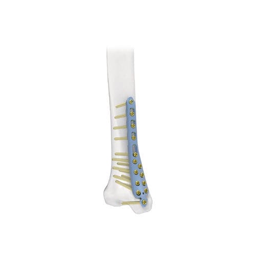 Placa de compresión para tibia - PNM1014 - NORMMED Medical Devices - porción distal / porción medial / bloqueada