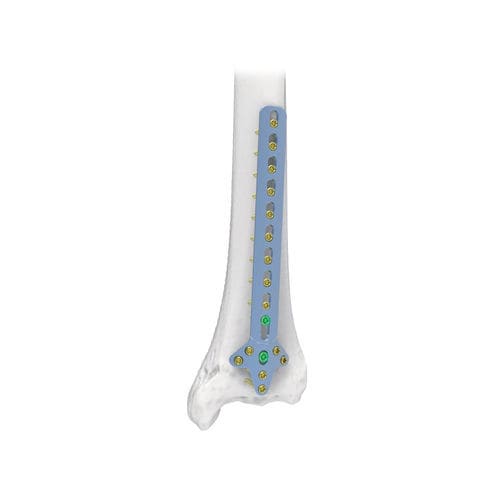 Placa de compresión para húmero - NORMMED Medical Devices - porción distal / bloqueada