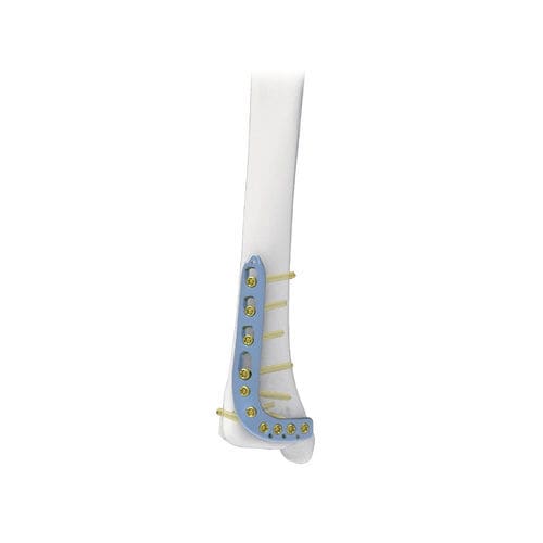 Placa de compresión para tibia - PNM1015 - NORMMED Medical Devices - porción distal / anterolateral / bloqueada