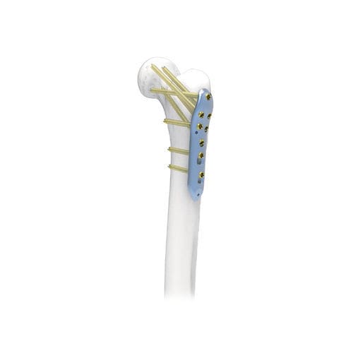 Placa de compresión para fémur - NORMMED Medical Devices - porción proximal / bloqueada / metálica