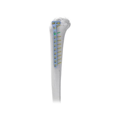 Placa de compresión para tibia - NORMMED Medical Devices - porción proximal / porción medial / metálica