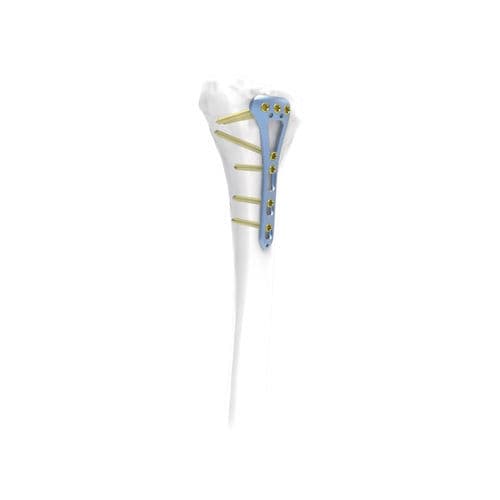 Placa de compresión para tibia - NORMMED Medical Devices - porción distal / posterolateral / bloqueada