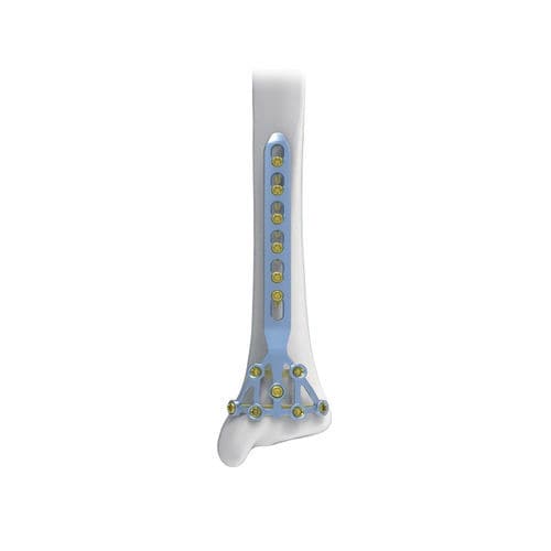 Placa de compresión para tibia - Pilon - NORMMED Medical Devices - bloqueada / metálica