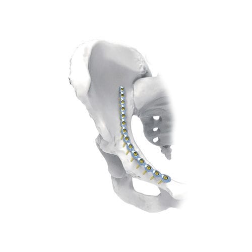Placa de compresión para pelvis - J - NORMMED Medical Devices - bloqueada / metálica