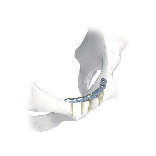 Placa de compresión para pelvis - NORMMED Medical Devices - bloqueada / metálica