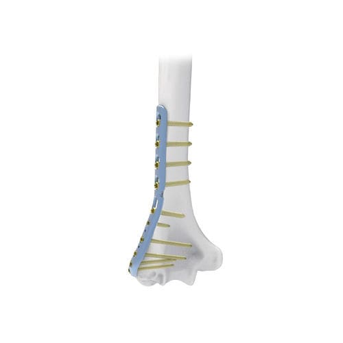 Placa de compresión para húmero - NORMMED Medical Devices - porción distal / lateral / bloqueada