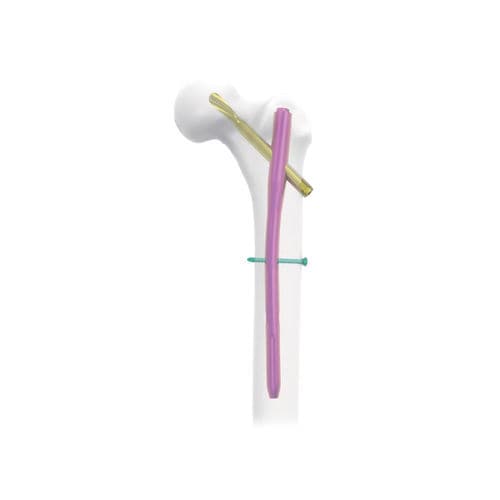 Clavo intramedular para fémur - NORMMED Medical Devices - para trocánter / metálico