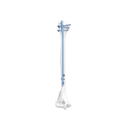 Clavo intramedular para húmero - NORMMED Medical Devices - fijación diafisaria / fijación proximal / metálico