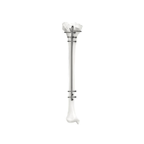Clavo intramedular para tibia - PNM3308 - NORMMED Medical Devices - fijación diafisaria / fijación proximal / metálico