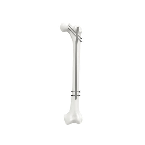 Clavo intramedular para fémur - NORMMED Medical Devices - fijación proximal / fijación diafisaria / metálico
