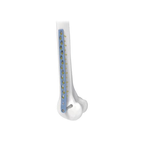 Placa de compresión para cóndilo femoral - NORMMED Medical Devices - bloqueada / metálica