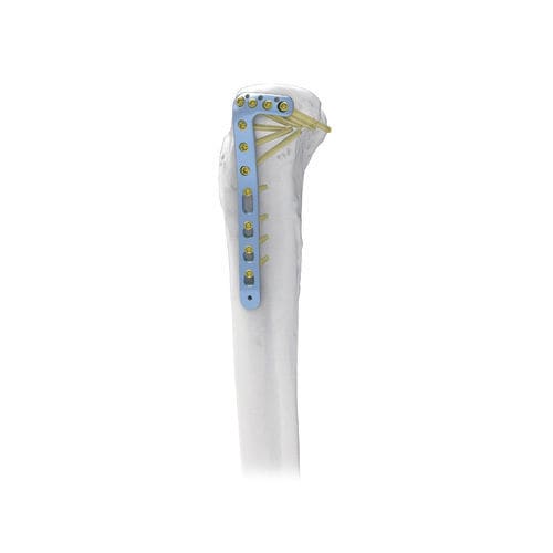 Placa de compresión para tibia - NORMMED Medical Devices - porción proximal / lateral / bloqueada