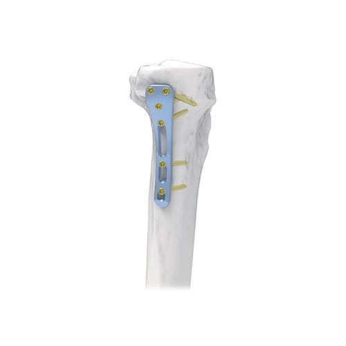 Placa de compresión para tibia - NORMMED Medical Devices - porción proximal / posteromedial / bloqueada