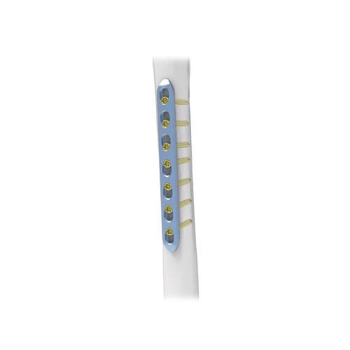 Placa de compresión para fragmentos óseos pequeños - NORMMED Medical Devices - bloqueada / metálica