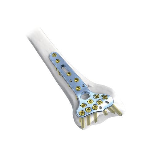 Placa de compresión para radio - Rim  - NORMMED Medical Devices - porción distal / bloqueada / metálica