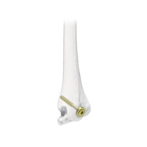 Tornillo de compresión ósea para húmero - NORMMED Medical Devices - canulado / metálico