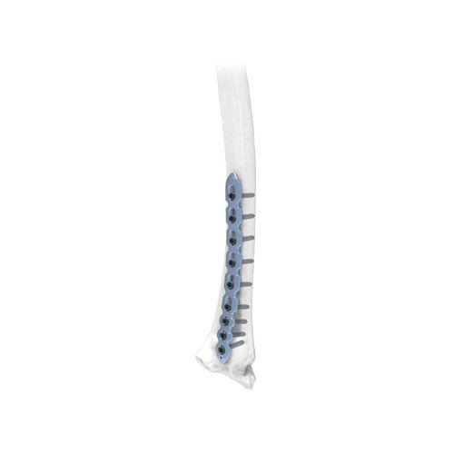 Tornillo de compresión ósea para radio - NORMMED Medical Devices - metálico