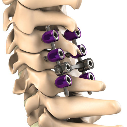 Sistema de osteosíntesis cervical - PCS - Aditus Medical - vía posterior / para adulto