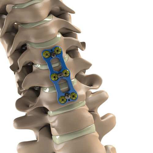 Placa de artrodesis cervical - Tİ-6Al-4V ELI  - Aditus Medical - bloqueada / metálica / 2 niveles
