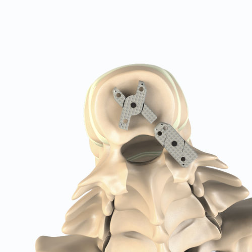 Caja intersomática lumbar - XLIF - Aditus Medical - vía posterior / vía lateral / de PEEK