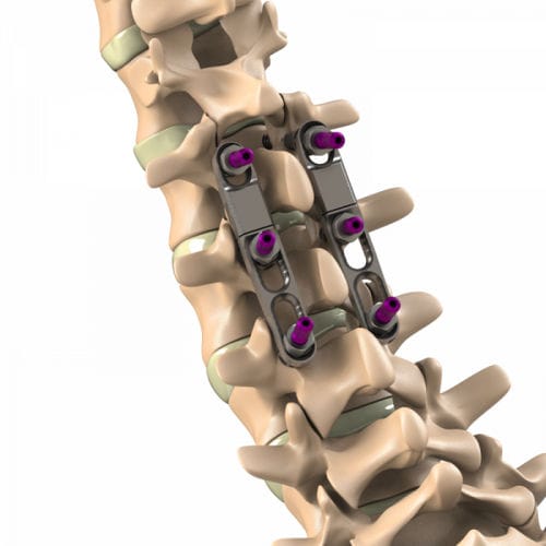 Sistema de osteosíntesis toracolumbar - Ti-6Al-4V ELI  - Aditus Medical - vía posterior / para adulto