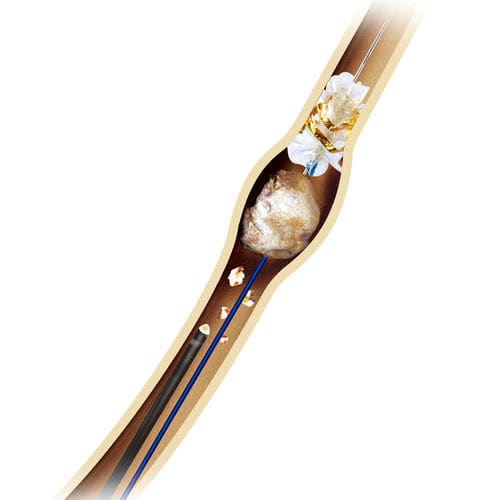Catéter de extracción de cálculos - Innovex Medical - ureteral / con revestimiento hidrófilo