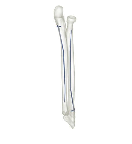 Clavo intramedular para radio - 83527 series - Peditst - para cúbito / de titanio