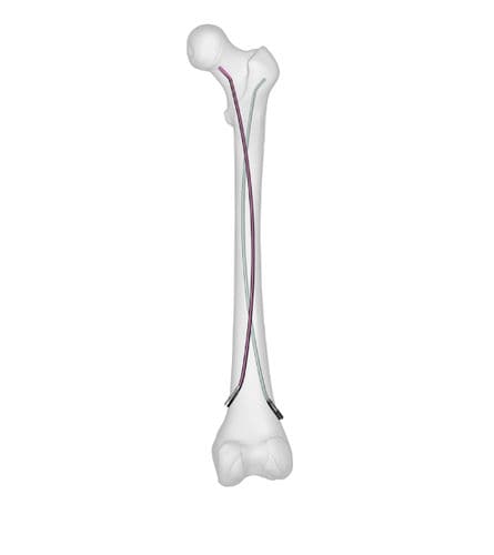 Clavo intramedular para fémur - 869867345 series - Peditst - de titanio