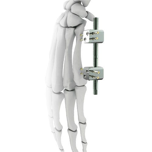 Fijador externo para articulación metacarpofalángica - minifix - Peditst - tubular / pediátrico