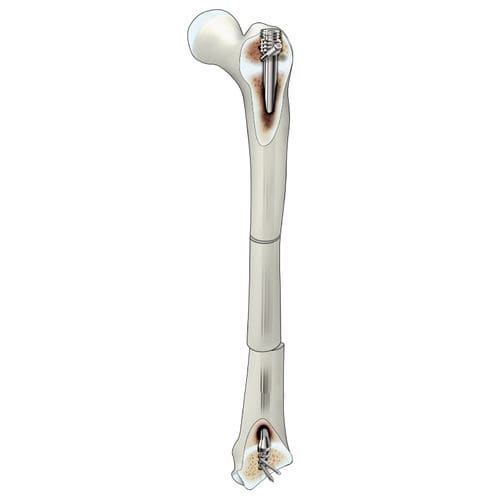 Clavo intramedular para fémur - D-SCOPE - Peditst - fijación proximal / fijación distal / pediátrico