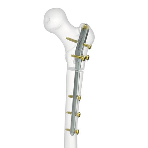 Clavo intramedular para fémur - Derona 360° - Peditst - fijación proximal / pediátrico / de titanio