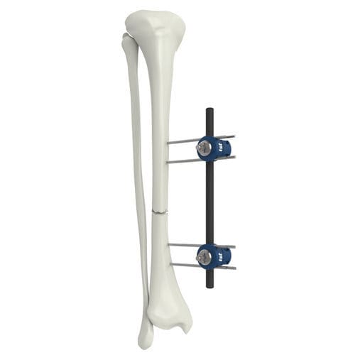 Fijador externo para radio - UMEF  - Peditst - tubular / pediátrico