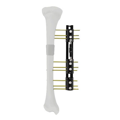 Fijador externo para tibia - LRS - Peditst - para fémur / tubular / pediátrico