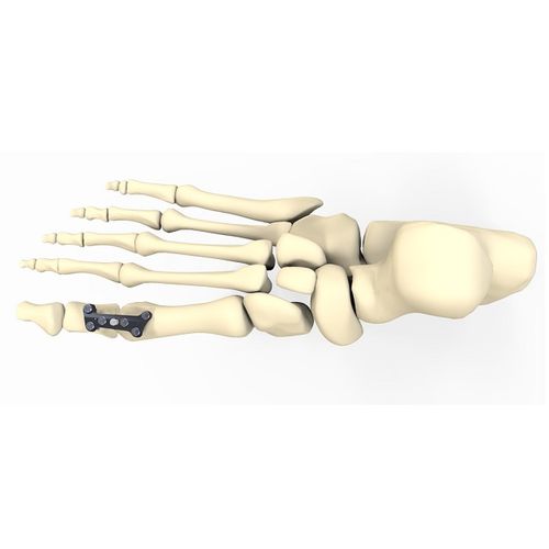 Placa de artrodesis para hallux valgus - FRC20 series - Aleda Medical - bloqueada / metálica