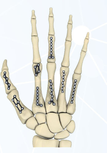 Placa de compresión para falange de la mano - FRC series - Aleda Medical - para metacarpo / bloqueada / metálica