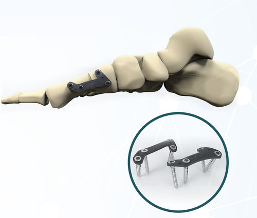 Placa de artrodesis para hallux valgus - FRC200 series - Aleda Medical - bloqueada / metálica