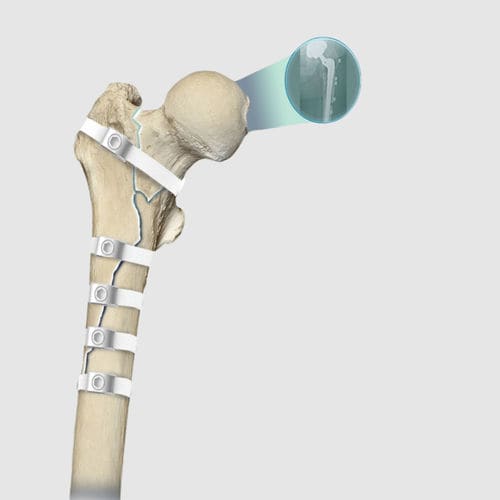 Alambre de cerclaje ortopédico para la revisión de prótesis de cadera - Ortholox® UHMWPE - Ortolog Medikal - polímero multifilamento