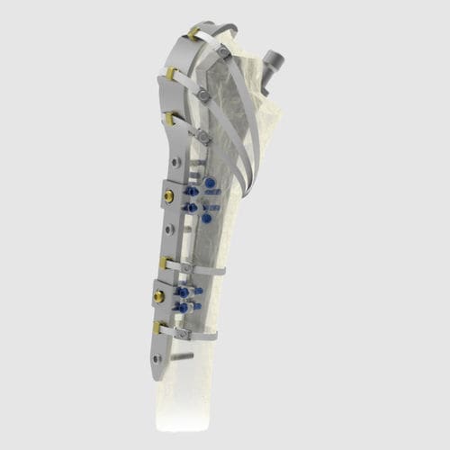 Placa de compresión para fractura femoral periprotésica - Ortholox®  - Ortolog Medikal - porción proximal / bloqueada / de titanio