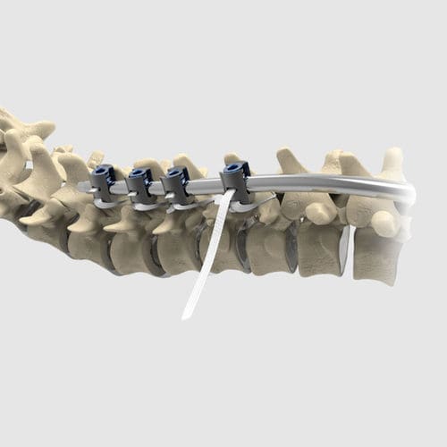 Banda de fijación por vía posterior de la columna vertebral pediátrica - Ortholox&reg; UHMWPE - Ortolog Medikal
