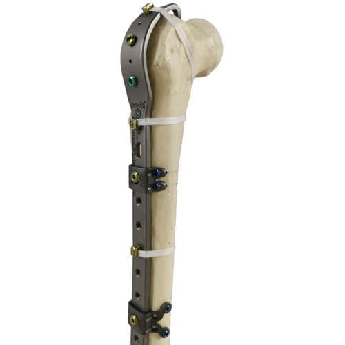 placa de compresión para fractura femoral periprotésica - Ortolog Medikal