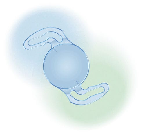 Lente intraocular tórica - EVToric - Aurolab - para astigmatismo