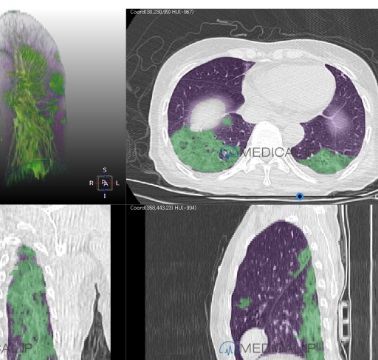 Software de análisis de imágenes - MEDIP Pneumovid - MEDICALIP Co., Ltd. - de visualización / con sistema de seguimiento / TDM