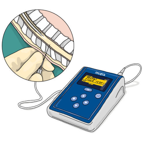 Analizador de quimica clinica de líquido cefalorraquídeo - Injeq IQ-Tip® - Injeq Ltd. - automático / de mesa